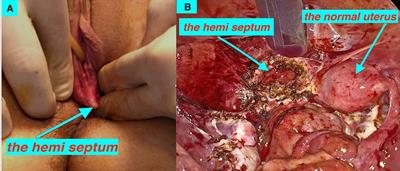 Reconsidering the best minimally invasive approach for patients with herlyn-werner-wunderlich syndrome: Should we push the frontiers for a better outcome?